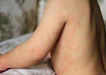 Alergi Makanan Tidak Bisa Dianggap Remeh: Tips, Pencegahan, dan Penanganan