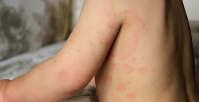 Alergi Makanan Tidak Bisa Dianggap Remeh: Tips, Pencegahan, dan Penanganan